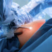 Discover the Benefits of Single Anastomosis Gastric Bypass in Sunshine Coast