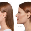 What to Expect from Kybella Treatments for Jawline Contouring and Long Term Results