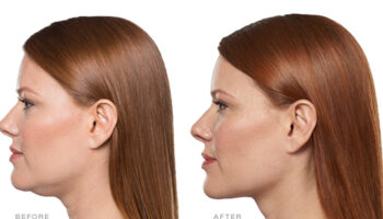 What to Expect from Kybella Treatments for Jawline Contouring and Long Term Results