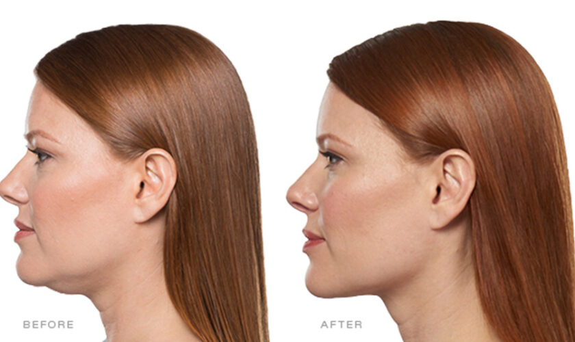 What to Expect from Kybella Treatments for Jawline Contouring and Long Term Results
