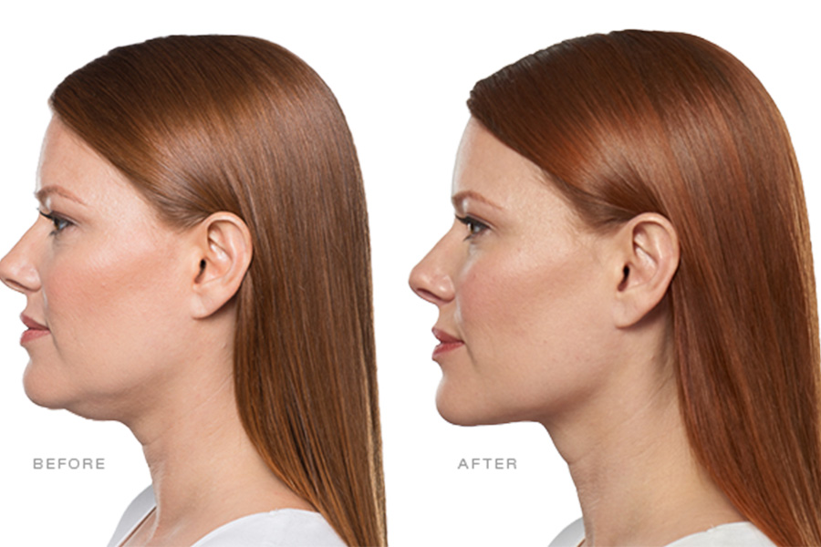 What to Expect from Kybella Treatments for Jawline Contouring and Long Term Results
