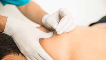 Dry Needling Physical Therapy for Muscle Tightness and Stiffness