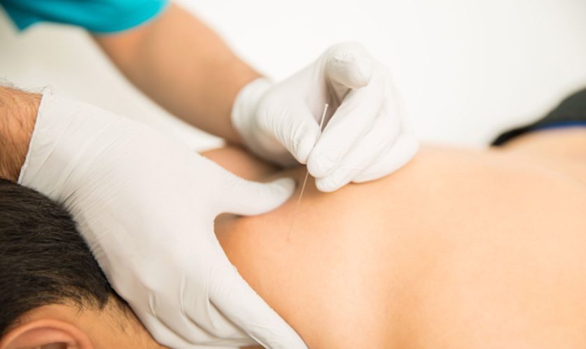 Dry Needling Physical Therapy for Muscle Tightness and Stiffness