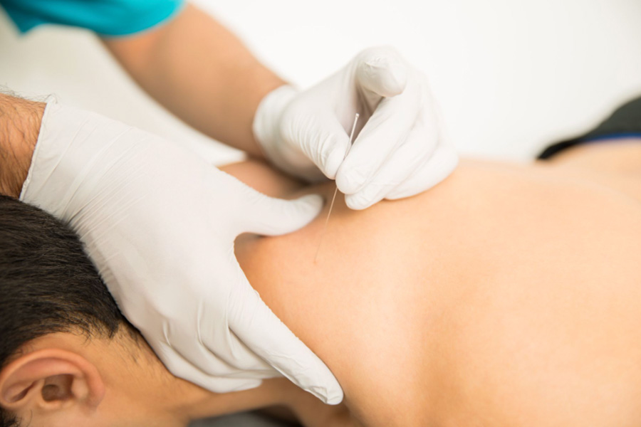 Dry Needling Physical Therapy for Muscle Tightness and Stiffness